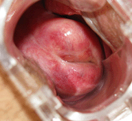 Adjuvant therapy of female patients with degenerative processes of the vulva and vulvodynia